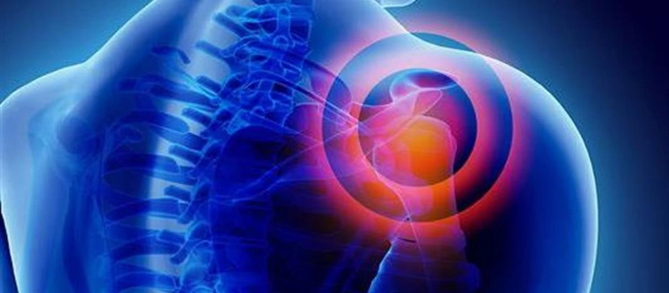 Όσα πρέπει να ξέρετε για το σύνδρομο παγωμένου ώμου - Ποιοι κινδυνεύουν
